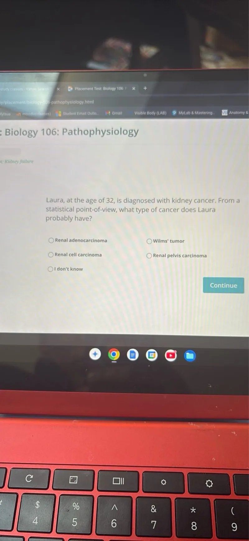 Biology 106: Pathophysiology
E: Kidney failure

Laura, at the age of 32 , is diagnosed with kidney cancer. From a statistical point-of-view, what type of cancer does Laura probably have?
Renal adenocarcinoma Wilms' tumor
Renal cell carcinoma Renal pelvis carcinoma
I don't know